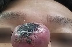 Chủ quan khi thấy có mụn nhỏ trên mũi, nam bệnh nhân nhập viện với khối ung thư 'khủng'