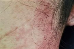 Toàn thân ngứa rát, nổi mẩn do thoa rượu gừng nghệ hạ thổ