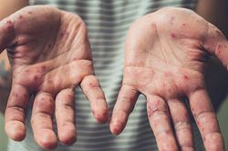 5 căn bệnh nguy hiểm thường dễ mắc vào mùa hè và cách chữa trị