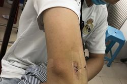 Cứu cánh tay cho chàng trai trẻ bị mà viêm mỏm trên lồi cầu ngoài