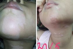 Kỹ thuật mới điều trị bệnh bạch biến da