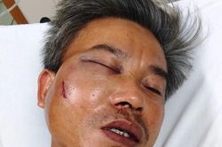 Nhân viên cây xanh bị đánh bầm dập: Nạn nhân phẫu thuật khẩn cấp do vỡ xương hàm