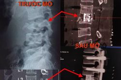 Cần Thơ: Thay đốt sống Titanium cứu bệnh nhân bị gãy nát cột sống