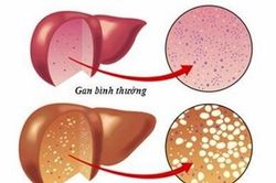 Bệnh gan nhiễm mỡ không do rượu làm tăng nguy cơ biến chứng ở bà mẹ và trẻ sơ sinh