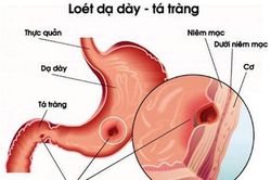 Thoái hóa niêm mạc dạ dày có nguy hiểm?