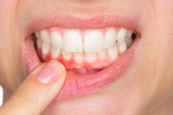 9 cách ngăn chặn chảy máu chân răng cực hiệu quả