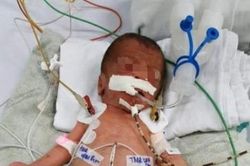 Tự dùng kéo cắt rốn ở nhà, bé sơ sinh bị uốn ván nguy kịch