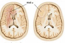 Dấu hiệu cảnh báo u não
