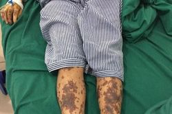 Phát hiện ca bệnh nhiễm liên cầu lợn nghi do ăn nem