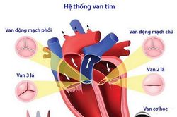 Phẫu thuật van tim: Những điều cần biết