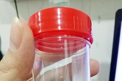 Trường hợp hy hữu: Dụng cụ trồng răng giả rơi vào dạ dày