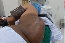 Cần Thơ: Cắt bỏ thành công khối u thần kinh nặng hơn 4,2kg