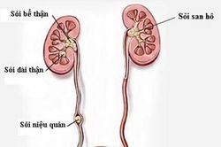 Biến chứng khó lường của sỏi niệu quản