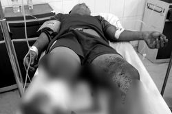 Hỗn chiến giữa đêm, thiếu niên 15 tuổi bị chém đứt lìa chân