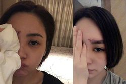 Chung Hân Đồng lần đầu đăng ảnh sau khi bị thương nặng
