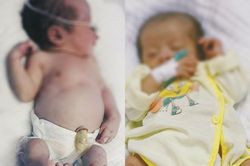 Bé sơ sinh ở Nghệ An bị bệnh giang mai