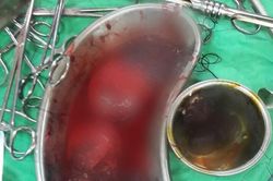 Đi bộ băng qua đường, người phụ nữ bị xe tông khiến thận vỡ đôi