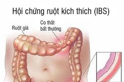 Cần trị dứt điểm hội chứng ruột kích thích