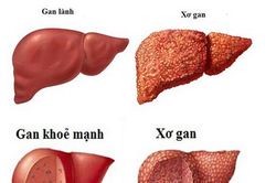Xơ gan khó chữa nhưng dễ phòng