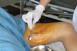 Bình rượu ổi phát nổ khiến nam thanh niên bị rách đùi