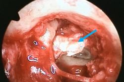 Bé gái suýt bị điếc vì khối cholesteatoma ăn mòn xương con trong tai giữa