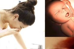 Bác sĩ trả lời: Mẹ phù nề chân tay và cân nặng bé có liên quan?