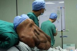 Căn bệnh khiến người mắc có hàng nghìn khối u bao phủ cơ thể