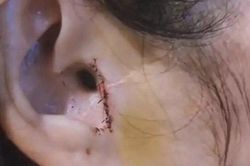 Gái xinh tá hỏa khi mất một mẩu tai sau phẫu thuật mũi