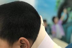 Bắt chước nhào lộn trên Tiktok, bé trai 10 tuổi bị chấn thương cổ