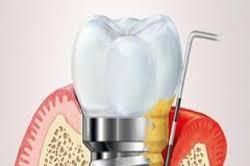 Viêm quanh Implant: Cách phòng ngừa và điều trị