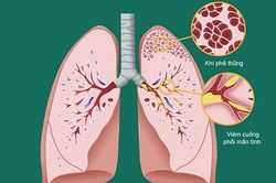 Hướng điều trị mới cho các bệnh viêm đường hô hấp mạn tính