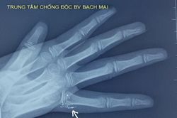 Lần đầu tiếp nhận bệnh nhi bị nhiễm độc thủy ngân từ nhiệt kế