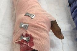 Cứu sống hai bệnh nhân vùng Bảy Núi suýt mất mạng vì rắn độc cắn