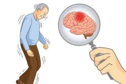 3 đặc điểm xuất hiện khi thức dậy vào buổi sáng cảnh báo bệnh nhồi máu não