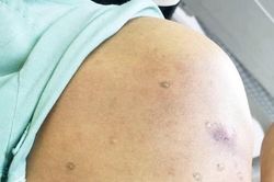 Bệnh nhân bị sốc phản vệ vì hơn 100 nốt ong đốt