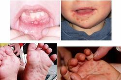 TPHCM: Báo động bệnh tay chân miệng gia tăng rất nhanh ở 8/24 quận huyện