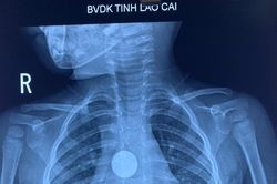 Cấp cứu thành công gắp dị vật pin cúc áo cho bệnh nhi 3 tuổi