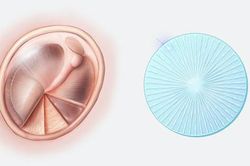 Phương pháp mới chữa bệnh thủng màng nhĩ