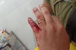 Người dân bị khỉ hoang tấn công thương tích nặng