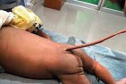 Kỳ lạ: Em bé sinh ra có... đuôi dài 12 cm