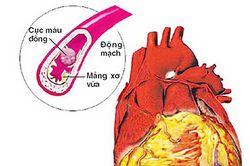 Hút thuốc lá - yếu tố nguy cơ của tăng huyết áp và các bệnh tim mạch