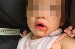 Xót xa bé gái mọc mụn rộp ở miệng, chẳng thể ăn uống, nguyên nhân khiến nhiều người 'giật mình'