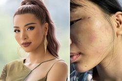 Sau khi tố chồng chưa cưới bạo hành dã man, Khả Trang hé lộ thêm tình trạng đáng lo của bản thân