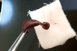 Con đỉa dài 6 cm chui vào mũi nam thanh niên 18 tuổi