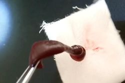 Đỉa dài 6cm sống trong mũi nam thanh niên