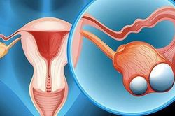 Thuốc chẩn đoán hình ảnh mới giúp xác định tổn thương ung thư buồng trứng