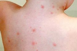 Trên người con gái nhỏ liên tục có chấm đỏ kỳ lạ, bố mẹ đưa đi khám mới ngớ người khóc ròng, tự trách mình vì cách giáo dục con sai lầm
