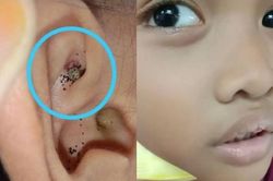 Bé trai đau tai, kiểm tra phát hiện 'quái vật' ghê rợn ký sinh