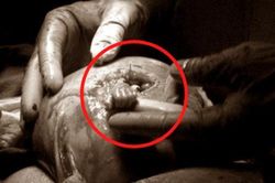 Thai nhi 21 tuần tuổi thò tay ra khỏi bụng mẹ và nắm chặt tay bác sĩ: Cuộc đời phi thường 20 năm sau khiến thế giới kinh ngạc