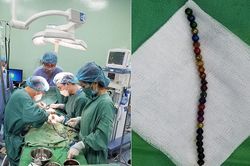 Nuốt 25 viên bi nam châm, bé 3 tuổi bị thủng ruột, tá tràng